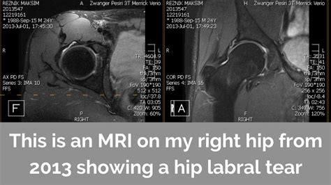 acetabular labral tear special tests|abnormal hip mri images.